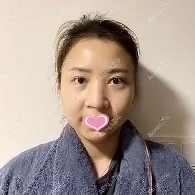 花2W多在东莞维多利亚做肋软骨鼻综合+鼻基底60天基本无吸收