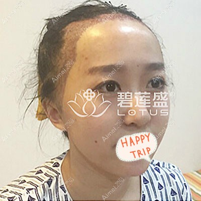 北京碧莲盛女发友植发际线当天效果