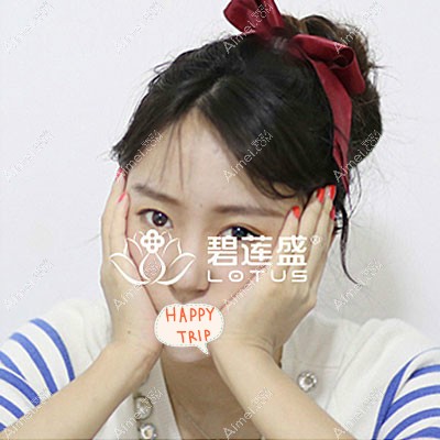 北京碧莲盛女发友植发际线一年后效果