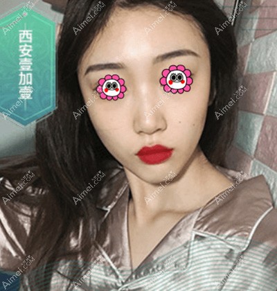 我做面部脂肪填充没有觉得肿胀期太难熬 我做面部脂肪填充没有觉得肿胀期太难熬