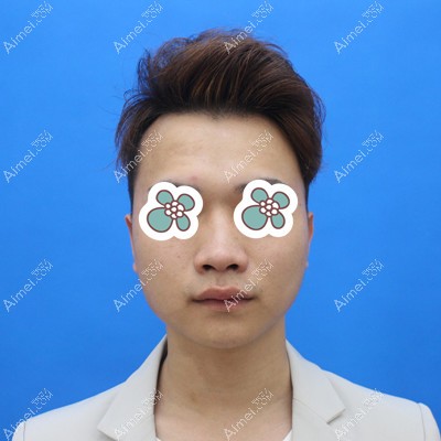 在包头华美整形做肋骨鼻综合前的我 在包头华美整形做肋骨鼻综合前的我