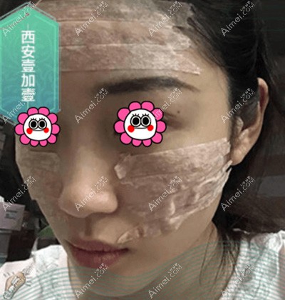 在西安壹加壹做面部脂肪填充第2天 在西安壹加壹做面部脂肪填充第2天