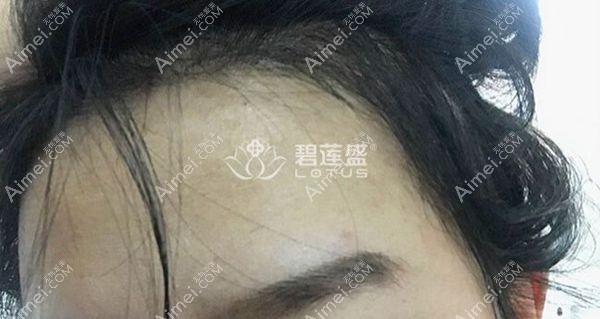 植完发际线3个月后扎头发效果.jpg 植完发际线3个月后扎头发效果.jpg