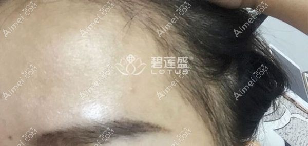 1个月的艺术种植发际线效果图.jpg 1个月的艺术种植发际线效果图.jpg