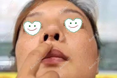 鼻假体歪斜必须换假体吗 鼻假体歪斜必须换假体吗