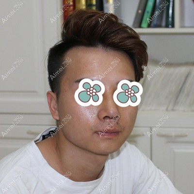 在包头华美做隆鼻手术一周拆线 在包头华美做隆鼻手术一周拆线