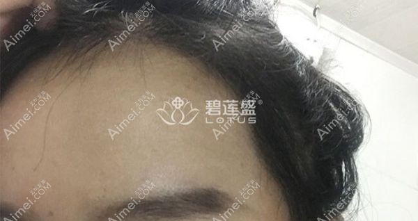 碧莲盛植发际线5个多月效果图.jpg 碧莲盛植发际线5个多月效果图.jpg