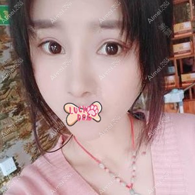 刘斌医生为我填充脂肪后4个月完全消肿 刘斌医生为我填充脂肪后4个月完全消肿