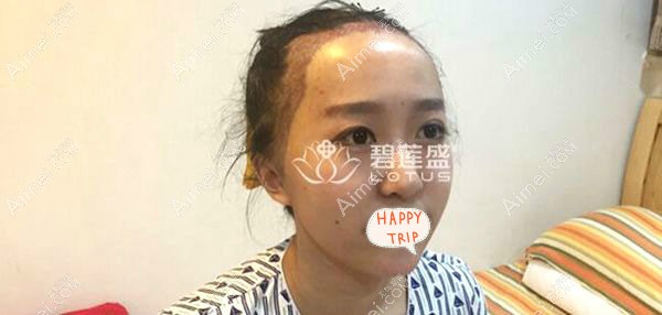 碧莲盛植发际线术后即刻效果.jpg 碧莲盛植发际线术后即刻效果.jpg