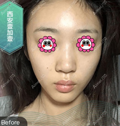 做面部脂肪填充前 做面部脂肪填充前