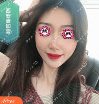 西安壹加壹医疗美容面部脂肪填充案例 西安壹加壹医疗美容面部脂肪填充案例