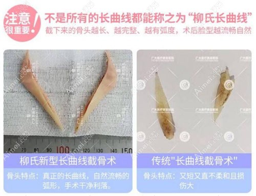 广州磨骨哪个医生好?柳超医生长曲线下颌角案例 广州磨骨哪个医生好?柳超医生长曲线下颌角案例