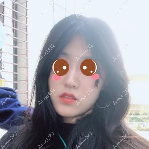 在重庆时光做下颌角手术后半年效果 在重庆时光做下颌角手术后半年效果