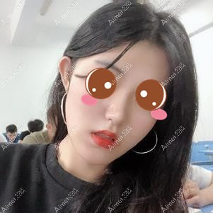 在重庆时光做下颌角手术后5个月恢复 在重庆时光做下颌角手术后5个月恢复