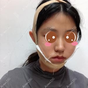 找重庆姜民范医生做下颌角后3天 找重庆姜民范医生做下颌角后3天