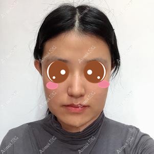 做下颌角手术前效果 做下颌角手术前效果