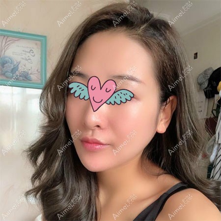 杭州华山连天美高俊明下颌角磨骨术后一年半效果 杭州华山连天美高俊明下颌角磨骨术后一年半效果