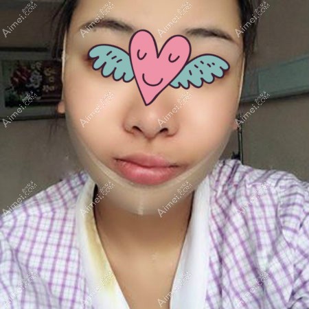 杭州华山连天美高俊明长曲线下颌角磨骨术后半个月效果 杭州华山连天美高俊明长曲线下颌角磨骨术后半个月效果