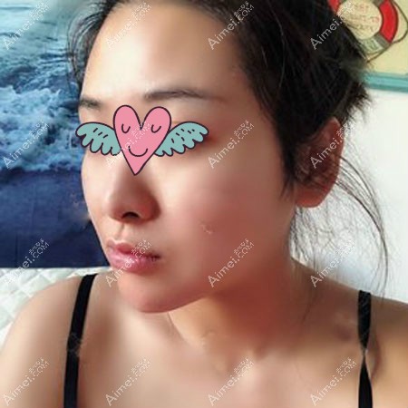 本人去杭州华山连天美找高俊明做下颌角磨骨四个月效果 本人去杭州华山连天美找高俊明做下颌角磨骨四个月效果