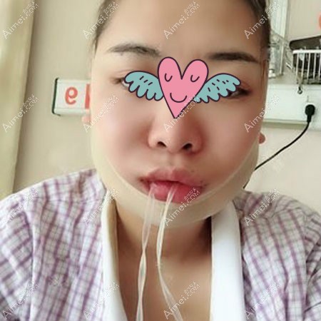 杭州高俊明医生长曲线下颌角磨骨术后第1天照片 杭州高俊明医生长曲线下颌角磨骨术后第1天照片