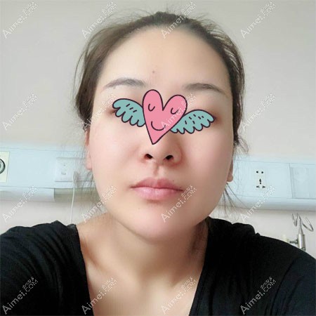 杭州华山连天美高俊明磨骨案例:术前照片 杭州华山连天美高俊明磨骨案例:术前照片