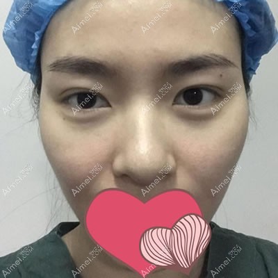 做国产威宁假体隆鼻前