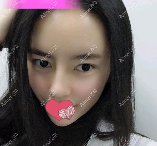 在邯郸京美整形做假体隆鼻三个月的恢复效果图 在邯郸京美整形做假体隆鼻三个月的恢复效果图