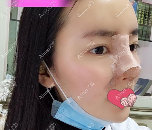 假体隆鼻术后第10天给鼻子拆线,弧度很自然 假体隆鼻术后第10天给鼻子拆线,弧度很自然