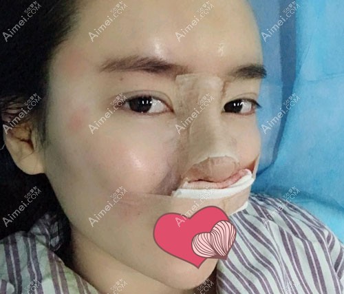 做完国产威宁假体隆鼻术后效果 做完国产威宁假体隆鼻术后效果