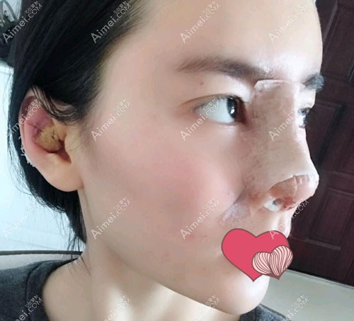 取耳软骨的位置,不会影响耳部的美观 取耳软骨的位置,不会影响耳部的美观