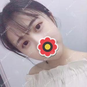 全切双眼皮一个半月效果 全切双眼皮一个半月效果
