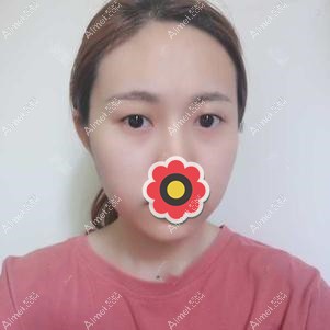 术前眼睛照片 术前眼睛照片