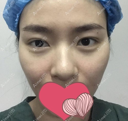 做假体隆鼻手术前 做假体隆鼻手术前