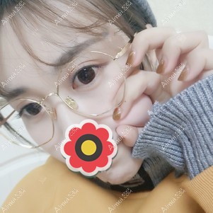 全切双眼皮五个月效果 全切双眼皮五个月效果