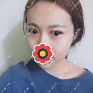全切双眼皮拆线后效果 全切双眼皮拆线后效果