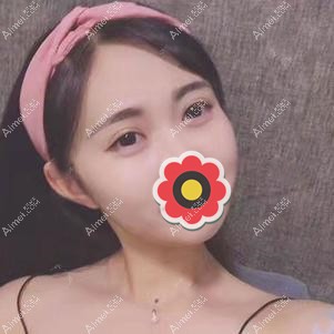 全切双眼皮三个月效果 全切双眼皮三个月效果