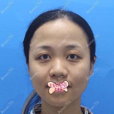 做耳软骨隆鼻术前是塌鼻子 做耳软骨隆鼻术前是塌鼻子