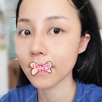 耳软骨鼻综合手术20天基本恢复 耳软骨鼻综合手术20天基本恢复