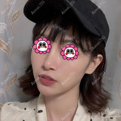 西安叶子面部脂肪填充术后照