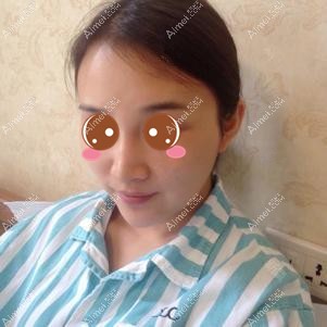 在重启徐铎丽格做二次脂肪填充前 在重启徐铎丽格做二次脂肪填充前