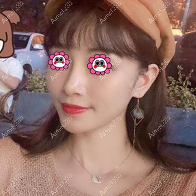 在西安叶子做面部脂肪填充一个多月基本恢复自然了 在西安叶子做面部脂肪填充一个多月基本恢复自然了