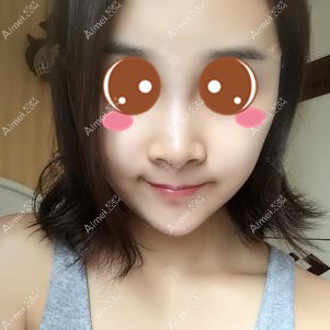 找徐铎院长做二次脂肪填充后13天 找徐铎院长做二次脂肪填充后13天