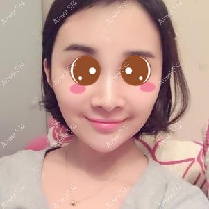 找徐铎院长做二次脂肪填充后63天 找徐铎院长做二次脂肪填充后63天