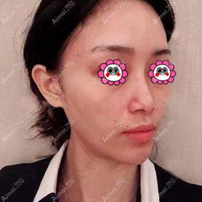 在西安叶子整形做面部脂肪填充前 在西安叶子整形做面部脂肪填充前