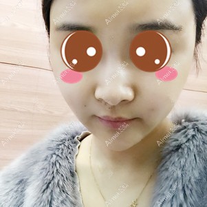 在重启徐铎丽格做二次脂肪填充术后2天 在重启徐铎丽格做二次脂肪填充术后2天