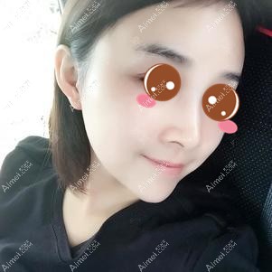 找徐铎院长做二次脂肪填充后30天 找徐铎院长做二次脂肪填充后30天