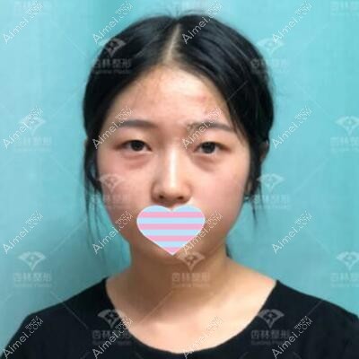术前照