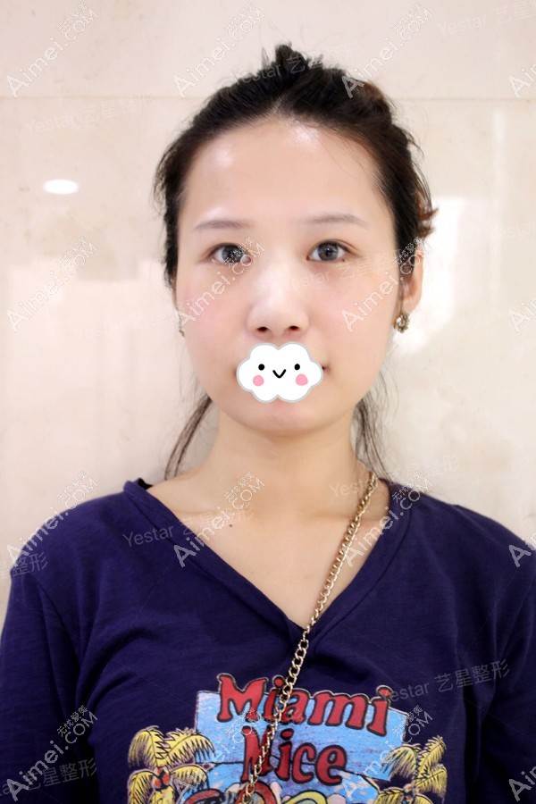 术前面诊双眼皮不对称 术前面诊双眼皮不对称