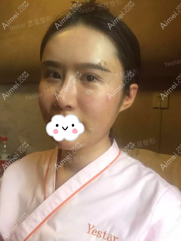 Yestar美杜莎综合美眼+BSK综合隆鼻三天消肿后 Yestar美杜莎综合美眼+BSK综合隆鼻三天消肿后