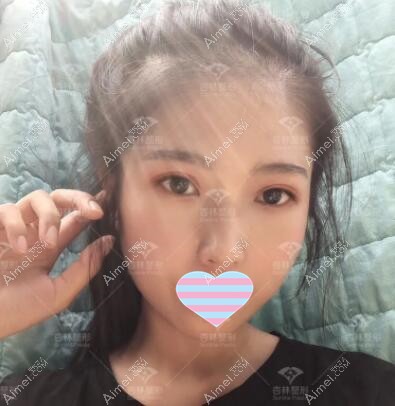 割双眼皮15天效果照 割双眼皮15天效果照